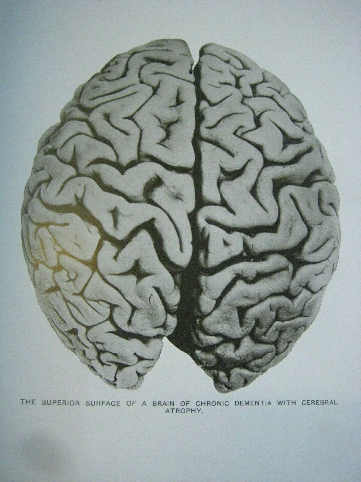 Rare ✅ Gross Morbid Anatomy_insane Brains_ 75 Large Pictures_antique Doctor Book
